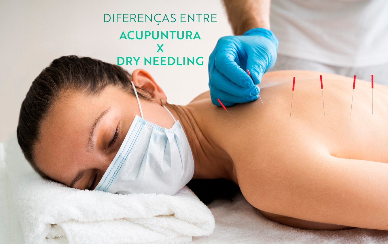 Qual a diferença da ACUPUNTURA para DRY NEEDLING?